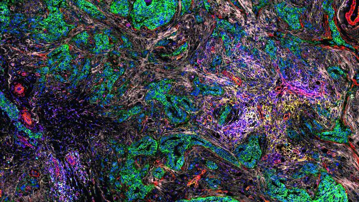 Cell DIVE multiplexed image of FFPE tissue section from human invasive ductal carcinoma (IDC). Cell DIVE multiplexed image of FFPE tissue section from human invasive ductal carcinoma (IDC)