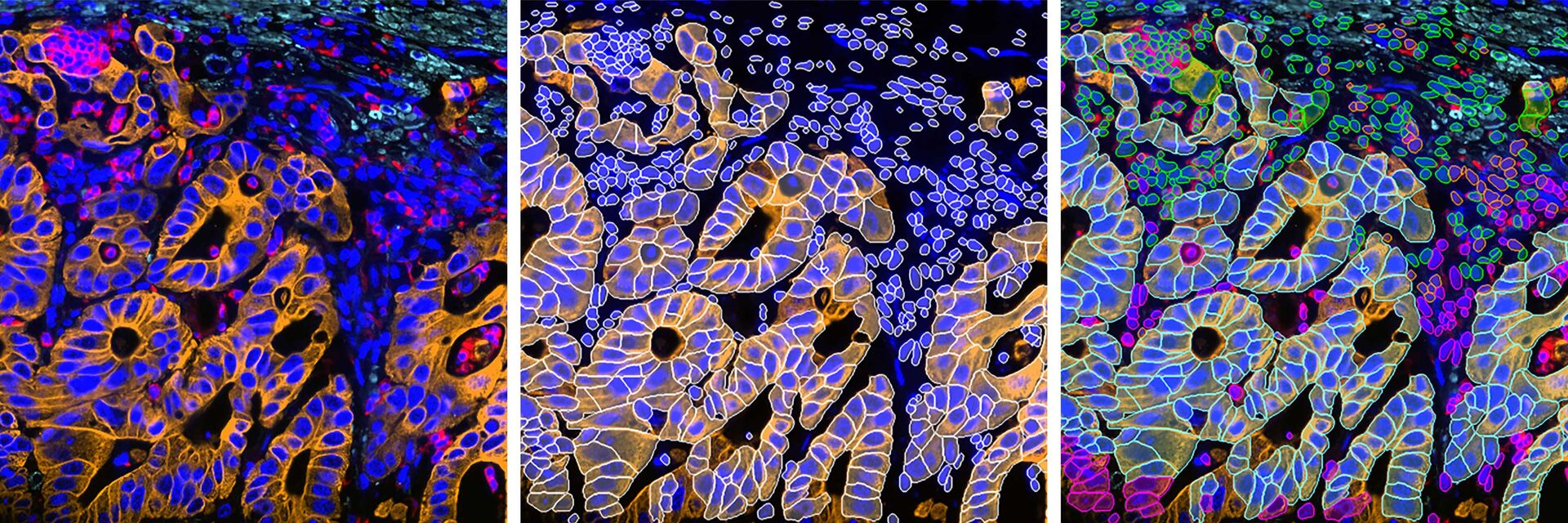 2D slice of colon cancer tissue stained with 30 markers and imaged using the Cell DIVE system. 