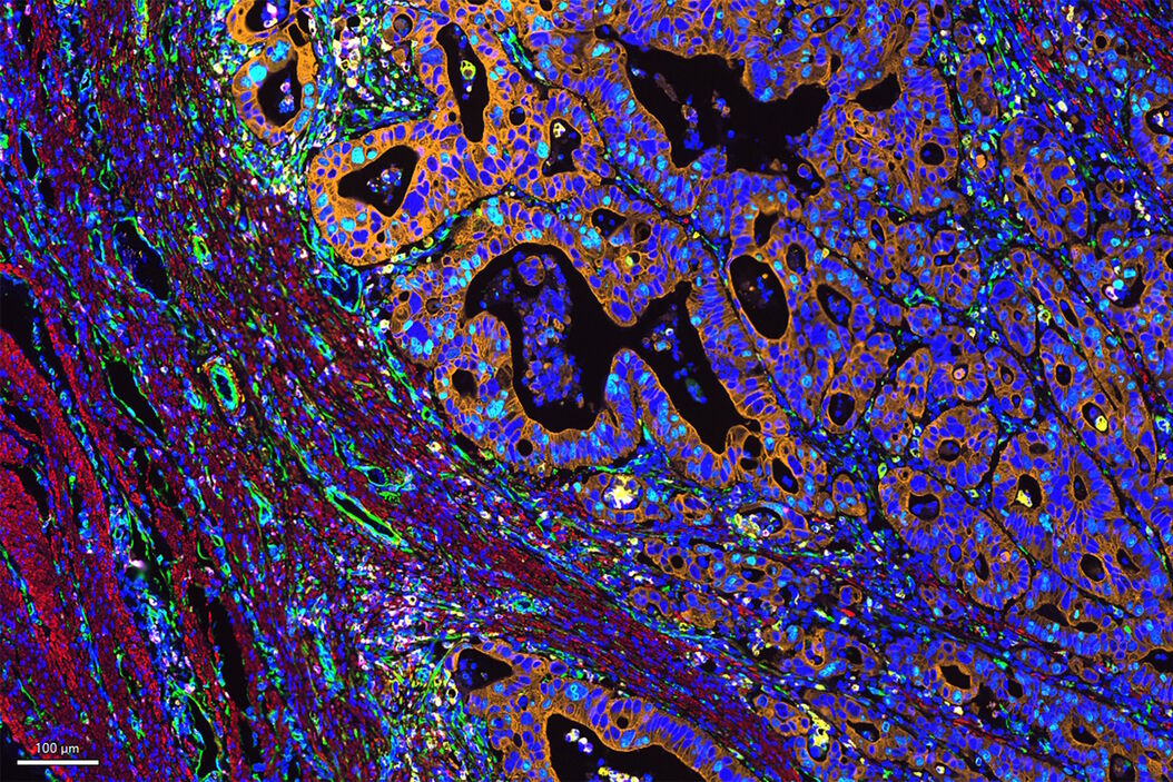 Multiplexed Cell DIVE imaging of Colon Adenocarcinoma (CAC) tissue. A panel of approximately 30 biomarkers targeted towards various leukocyte lineages, epithelial, stromal, and endothelial cell types was utilized to characterize the tumor immune microenvironment in human colon adenocarcinoma (CAC) tissue. Colon_Adenocarcinoma_CAC_tissue_multiplexed_Cell_DIVE_image.jpg