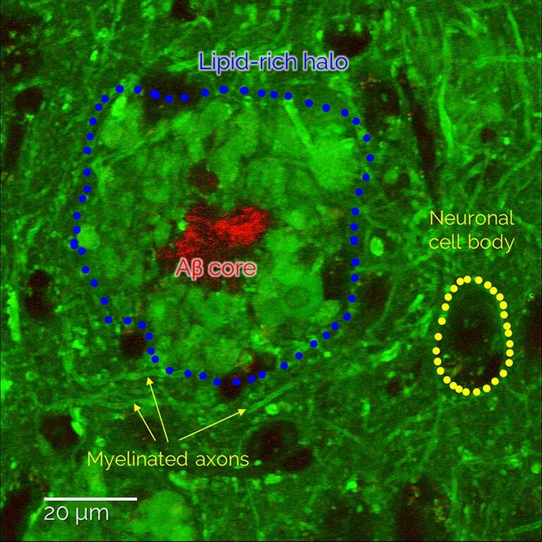 Placas de amiloide-β e depósitos de lipídio patológicos associados, visualizados em tecidos cerebrais não identificados. A análise espectroscópica mostra um enriquecimento dos lipídios da membrana e um esgotamento do colesterol em comparação com as estruturas cerebrais saudáveis próximas, fornecendo uma nova oportunidade para estudar as conexões entre o metabolismo lipídico e a patologia de Alzheimer. Amostra de cortesia do Dr. Martin Fuhrmann, Andrea Baral, Centro Alemão de Doenças Neurodegenerativas, Bonn.