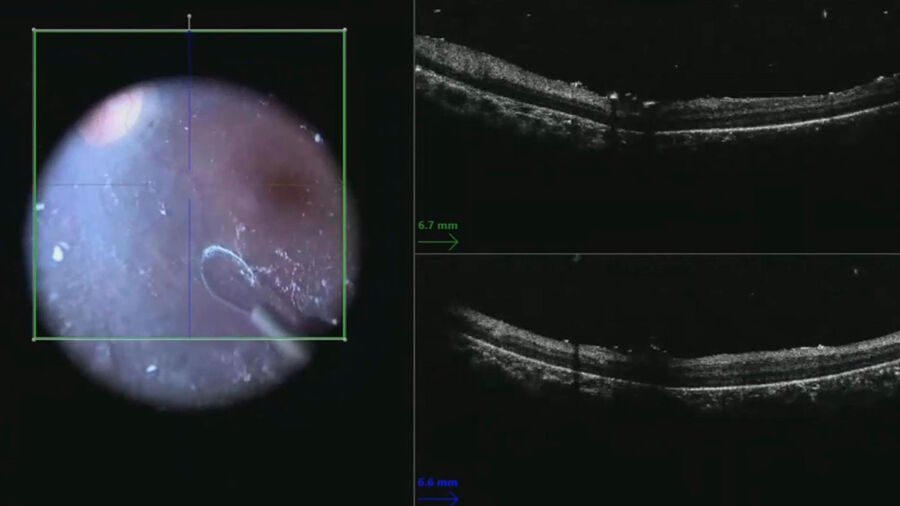 Figure 3: Live intraoperative OCT is helpful for illustrating the plane between the retina and the hyaloid face. Image courtesy of Robert A. Sisk, MD, FACS, Cincinnati Eye Institute.