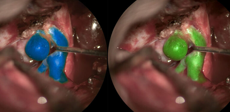 Images courtesy of Cleopatra Charalampaki, MD, PhD, Professor of Neurosurgery, Department of Neurosurgery, Cologne Medical Center, Germany.