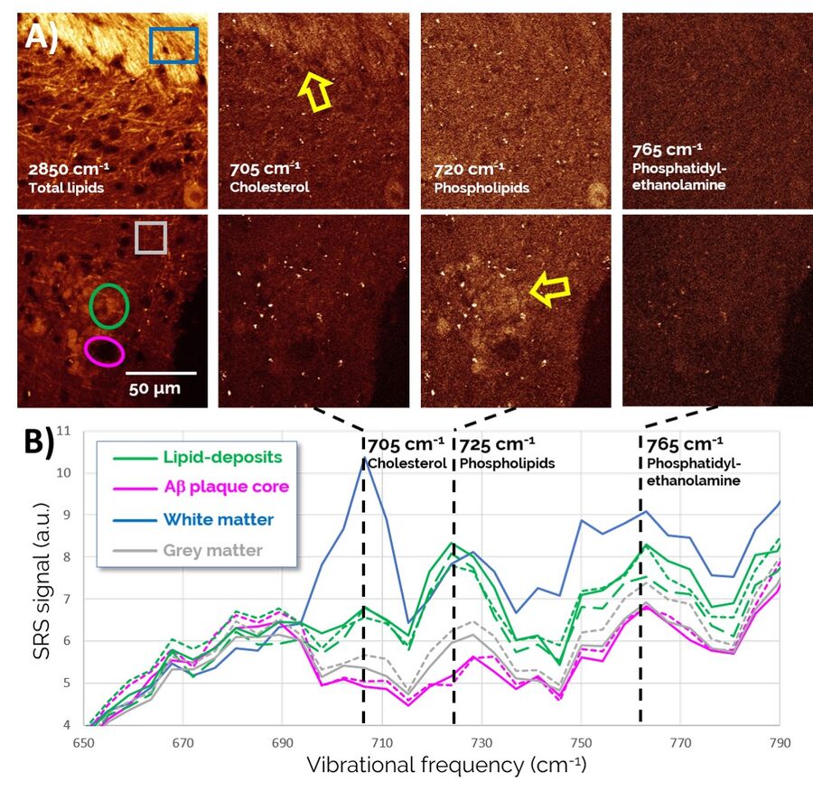 SRS spectroscopic imaging shows a differential localization of certain lipid species to healthy and pathological brain structures.