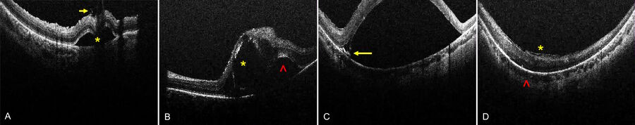 Figure 4: Intraoperative OCT reveals insights into microanatomical retinal changes. A) Bleb initiation with engagement of subretinal cannula in retinotomy and subretinal fluid (yellow asterisk). Note the ILM flap from limited peeling (yellow arrow). B) Intraretinal schisis (yellow asterisk) and subretinal fluid (red caret) revealed in the same raster scan after bleb created with beveled subretinal cannula.  Intraretinal blebs tend to track into the subretinal space as they expand. C) RPE tension lines (yellow arrow) at the base of a bullous bleb indicate strong retinal-RPE adhesion and risk for further stretching with permanent RPE changes. D) Epiretinal membranes (yellow asterisk) may limit bleb creation. Increased posterior curvature (red caret) may promote high bleb formation and risk for foveal inversion and macular hole. Images courtesy of Robert A. Sisk, MD, FACS, Cincinnati Eye Institute.