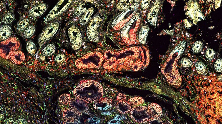 Pancreatic Ductal Adenocarcinoma with 11 Apoptosis biomarkers shown – BAK, BAX, BCL2, BCLXL, Caspase9, CIAP1, NaKATPase, PCK26, SMAC, Vimentin, and XIAP. Pancreatic Ductal Adenocarcinoma with 11 Apoptosis biomarkers shown – BAK, BAX, BCL2, BCLXL, Caspase9, CIAP1, NaKATPase, PCK26, SMAC, Vimentin, and XIAP.