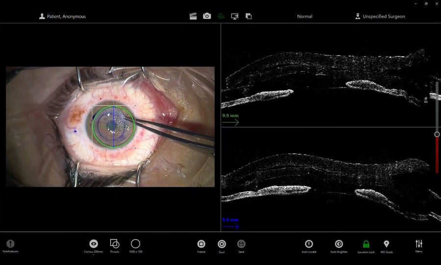 Figure 6: The EnFocus intraoperative OCT shows fine details required to make informed surgical decisions in corneal surgeries. Image courtesy of Prof. Fontana.