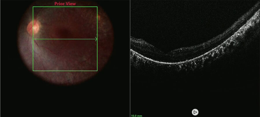 Figure 2: Macular scan performed to document the pre-injection anatomy. Image courtesy of Robert A. Sisk, MD, FACS, Cincinnati Eye Institute.