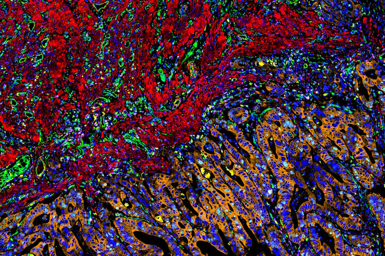 AI-Powered Multiplexed Image Analysis to Explore Colon Adenocarcinoma ...