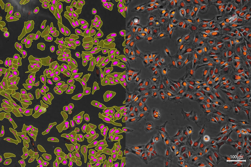 AI-based transfection analysis (left) of U2OS cells which were transfected with a fluorescently labelled protein. A fluorescence image of the cells (right) is also shown. The analysis and imaging were performed with Mateo FL. AI-based_analysis_of_U2OS_cells_transfected_with_fluorescently_labelled_protein.jpg