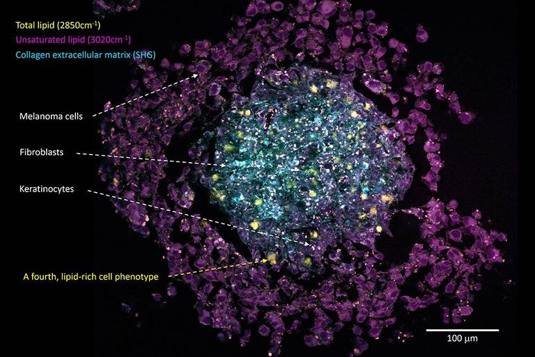 L’imagerie SRS sans marquage révèle l’architecture noyau-enveloppe d’un modèle sphéroïde de cancer de la peau multicellulaire et révèle l’apparition d’un phénotype cellulaire riche en lipides inattendu (cellules jaune vif isolées). Échantillon fourni avec l’aimable autorisation du Dr Julia Klicks, Prof. Rüdiger Rudolf, Hochschule Mannheim, Allemagne.