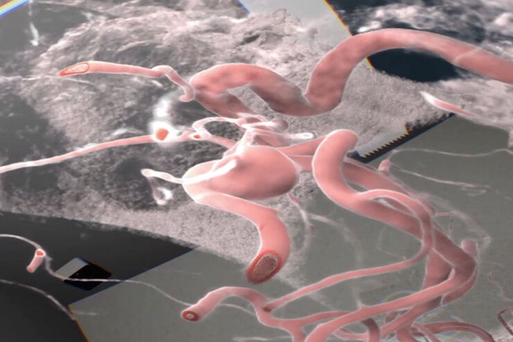 Analysis of an aneurysm with Virtual Reality. Image courtesy of Prof. Raphael Guzman. Analysis of an aneurysm with Virtual Reality. Image courtesy of Prof. Raphael Guzman.