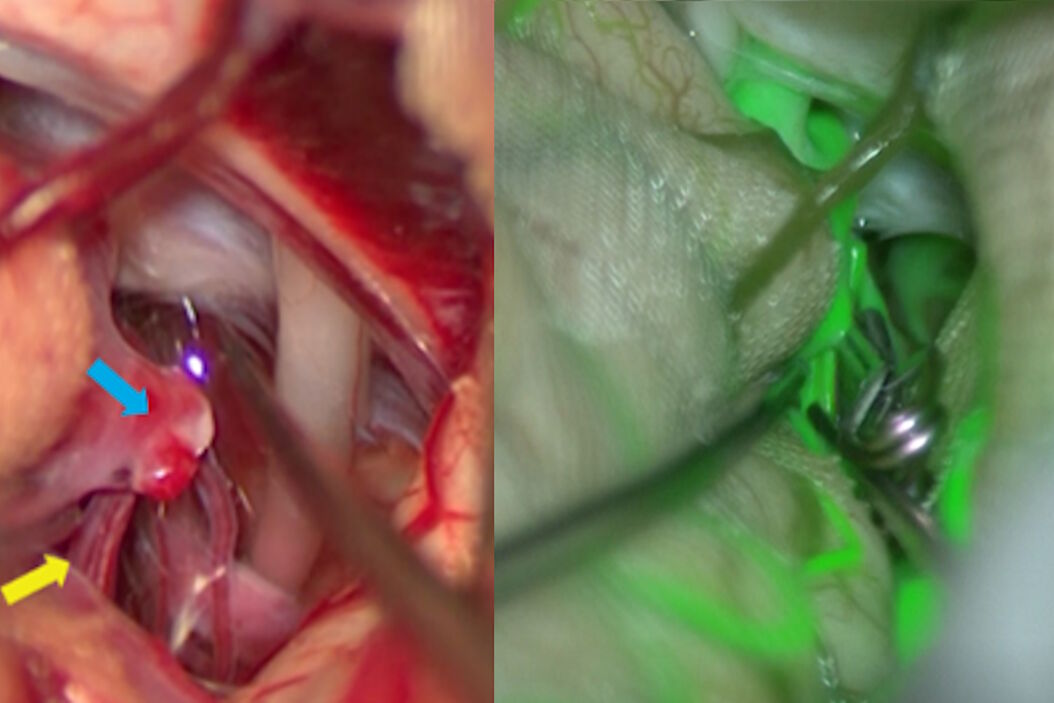 GLOW800 Augmented Reality Fluorescence used for real-time blood flow visualization in aneurysm clipping surgery Cha_bifurcation_aneurysm_teaser.jpg