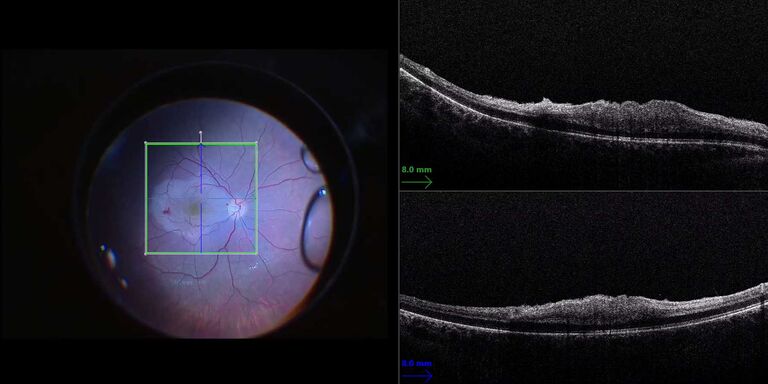 Microscope view of the retina (left) supplemented with EnFocus OCT (right) to visualize membrane layers during membrane peeling. Image courtesy of Dr. Massimo D’Atri, Cagliari, Italy.