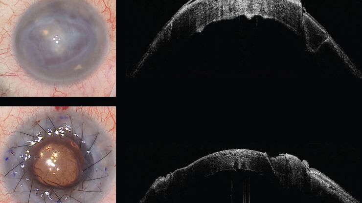 Keratoplasty of pathologic cornea