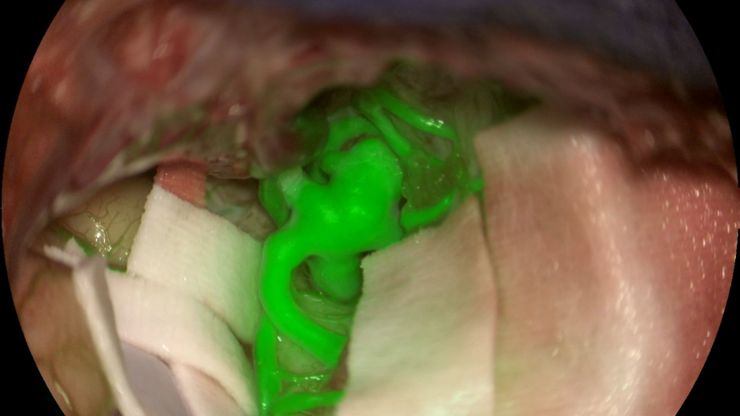 Aneurysm shown with GLOW800 AR fluorescence application. Image courtesy of Prof. Jacques Guyotat, Hôpital Neurologique Pierre Wertheimer, Lyon. Aneurysm shown with GLOW800 AR fluorescence application. Image courtesy of Prof. Jacques Guyotat, Hôpital Neurologique Pierre Wertheimer, Lyon