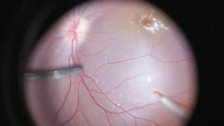 Completed Bleb, courtesy of Robert A. Sisk, MD, FACS, Cincinnati Eye Institute.