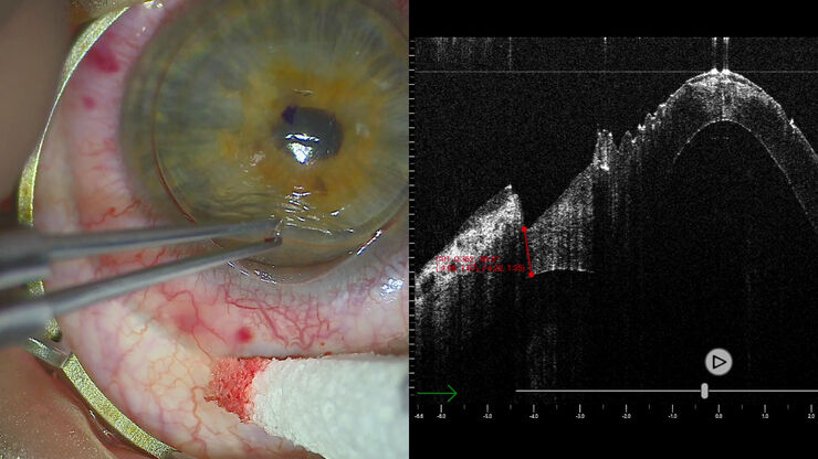 Messung während der Hornhautlamellentransplantation, Dr. Enrico Bertelli, Bozen, Italien