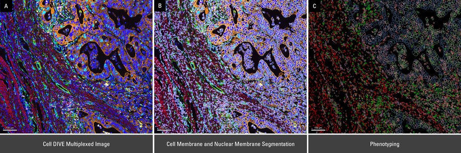 (A) Cell DIVE multiplexed image was utilized to perform (B) cell membrane and nuclear membrane segmentation to identify individual cells using AI-powered multiplexed cell detection recipe, followed by (C) user-defined phenotyping on Aivia to assign phenotypic markers to individual cells for further spatial analysis. (C) demonstrates various user-defined phenotypes by color.