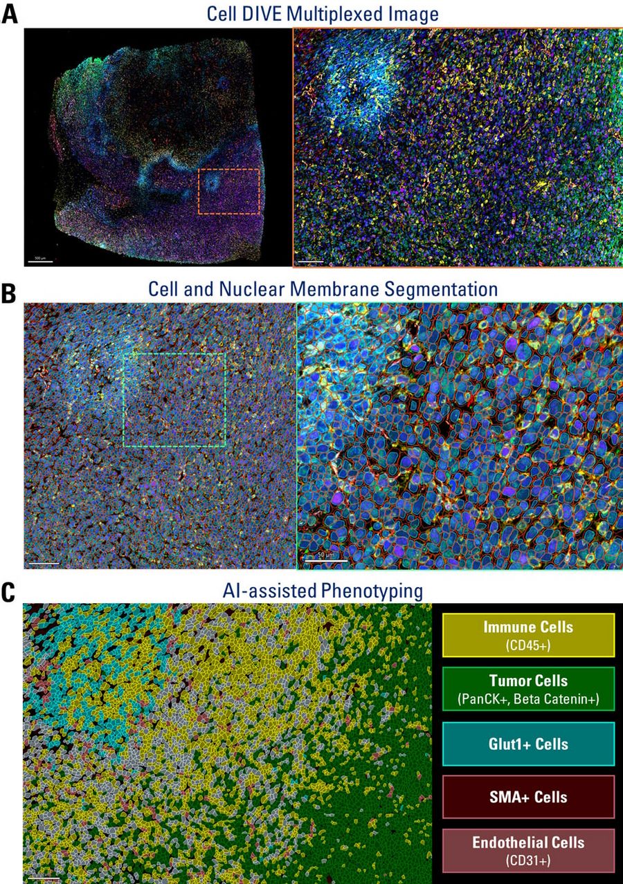 Figure 1: Multiplexed Image Analysis using Aivia. A. Cell DIVE multiplexed image of whole tissue and zoomed in panel. B. Cell and nuclear membrane segmentation using multiplexed cell detection recipe on Aivia to identity all cells as individual objects. C. AI-assisted phenotyping to identify various cells belonging to various categories such as immune cells, tumor cells, fibroblasts, endothelial cells, and Glut1-positive cells (which could belong to different cell types including immune or tumor cell types).