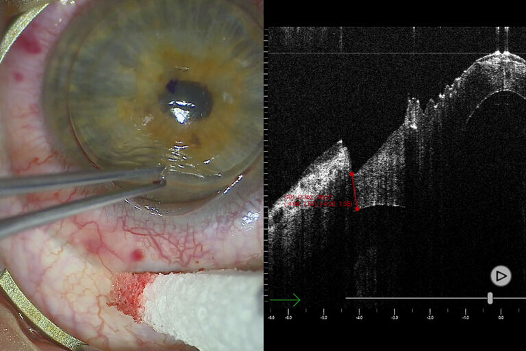 Messungen mit intraoperativem EnFocus OCT während der tiefen anterioren lamellären Keratoplastik bei Keratokonus (DALK) helfen bei der Quantifizierung der Schnitttiefe. Mit freundlicher Genehmigung von Dr. Enrico Bertelli, Leiter der Abteilung für Augenheilkunde, Krankenhaus Bozen, Italien