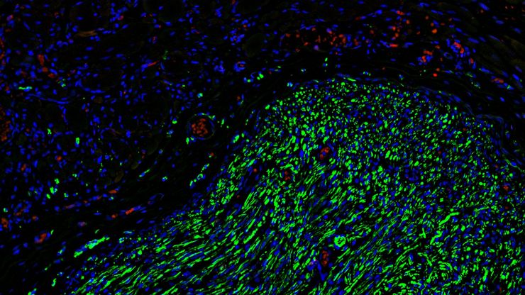 Fluorescence microscopy of sectioned tissue, showing the interface between the extensor digitorum longus muscle and the common peroneal nerve in the adult rat. Regenerative peripheral nerve interface (RPNI) at 2 weeks. Image acquired using Mica. Fluorescence microscopy of sectioned tissue, showing the interface between the extensor digitorum longus muscle and the common peroneal nerve in the adult rat. Regenerative peripheral nerve interface (RPNI) at 2 weeks. Image acquired using Mica. Stained for nuclei (blue), neurofilaments (green) and S100B (red). Image courtesy of Dr. Aaron Lee, Department of Bioengineering (Lab of Dr. Rylie Green), Imperial College London.