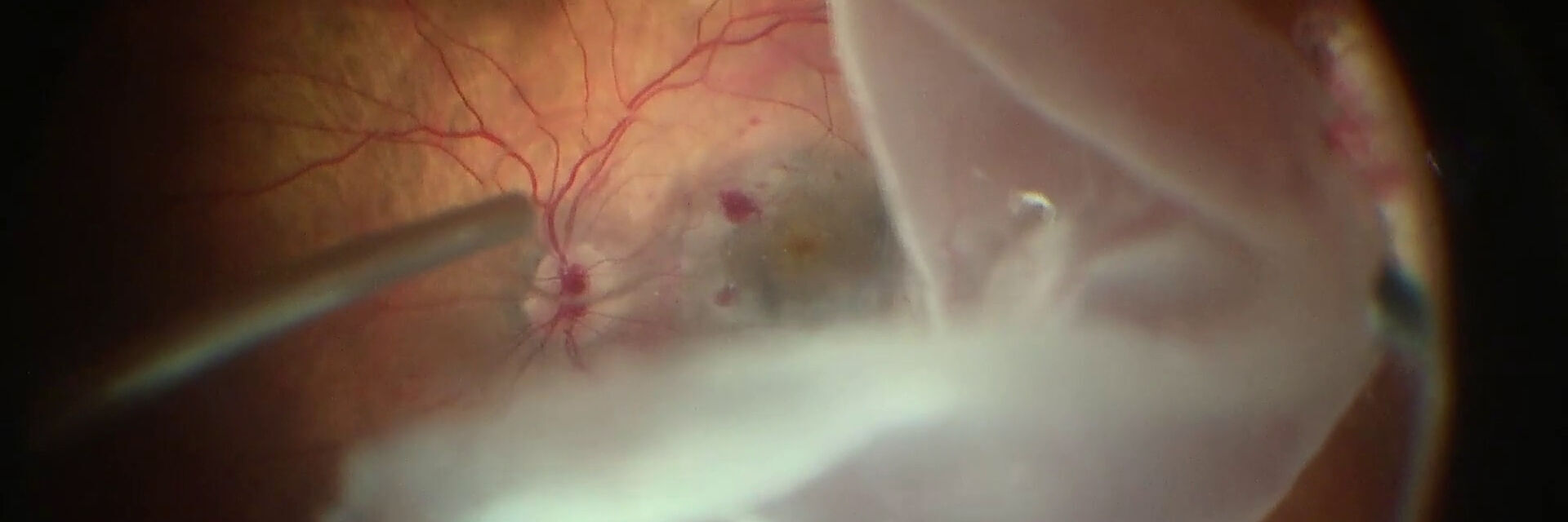 Microscope ophtalmique Proveo 8 pour chirurgie de la rétine