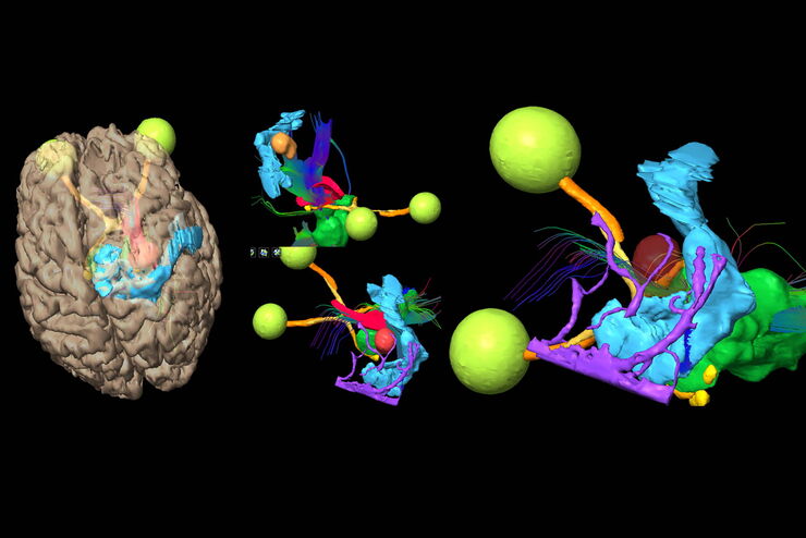 Brain tumor surgical planning leveraging Augmented Reality. Image courtesy of Prof. Philippe Bijlenga. Brain tumor surgical planning leveraging Augmented Reality. Image courtesy of Prof. Philippe Bijlenga.
