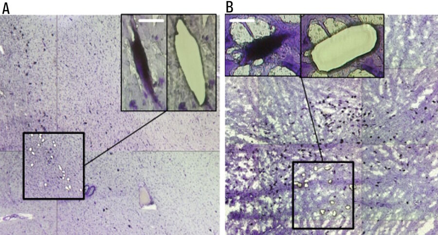 Fig. 3: LMD and mRNA-expression analysis of individual SN DA neurons from human PD and control postmortem brains. Pools of neuromelanin-positive [NM(+)] neurons were isolated via LMD from cresyl-violet-stained horizontal midbrain cryo-sections from PD (A) and control brains (B). 
