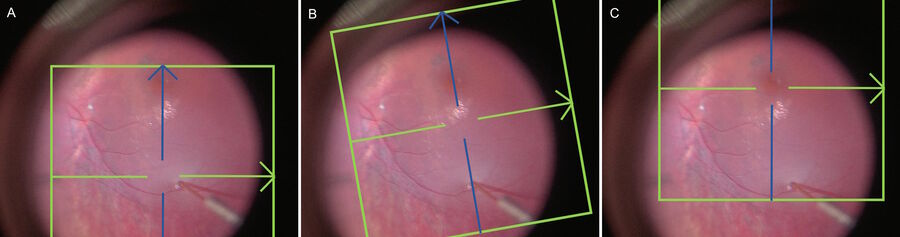Figure 1: Techniques for Intraoperative OCT during Bleb Formation and Propagation Variable Techniques: A) Horizontal B-Scan is placed on the retinotomy and vertical raster is kept on the fovea, B) A highresolution single line scan is oriented with the retinotomy on one end and the fovea on the other, C) Monitor fovea only (if image injection crosshairs interfere with visualizing the retina in real time)