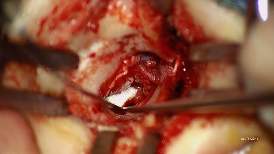 Figure 5: Placement of the composite perichondrial and cartilage island graft. Image courtesy of Dr. Sean Flanagan