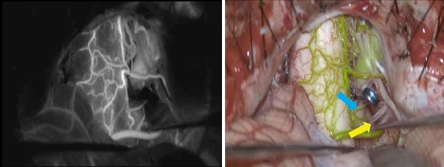 Fig. 2: Partially thrombosed large vertebral artery aneurysm. Left: Assessing proximal vertebral artery clip occlusion through black and white ICG imaging. Right: Assessing proximal vertebral artery clip occlusion through Real-Time ICG. 