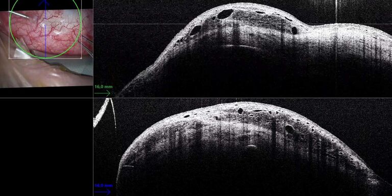 Intraoperatives OCT-Bild mit Injektion von 5-Fluorouracil (5-FU) nach Trabekulektomie. Bilder mit freundlicher Genehmigung von Prof. Gerd Geerling, MD, PhD, FEBO, Abteilung für Augenheilkunde, Universitätsklinikum Düsseldorf, Deutschland