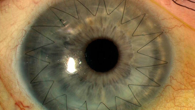 Corneal transplantation. Image courtesy of Mr. David Anderson. Corneal transplantation. Image courtesy of Mr. David Anderson.
