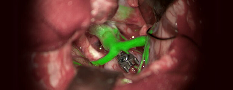 GLOW800 AR fluorescence application for vascular surgery