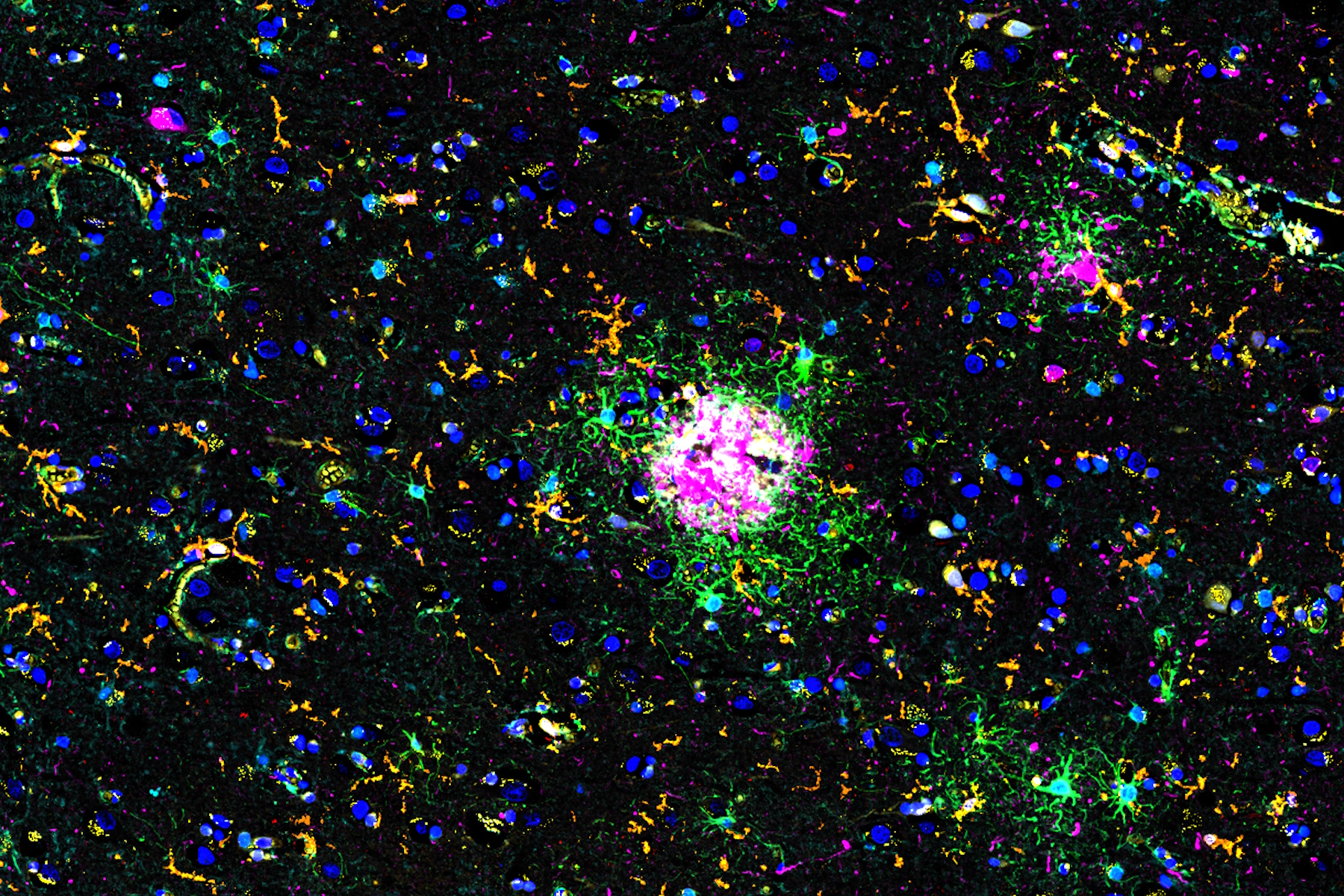 Multiplexed Cell DIVE imaging of Adult Human Alzheimer’s Brain Tissue labelled with 15 antibodies targeted towards markers specific to astrocytes (GFAP, S100B), microglia (TMEM119, IBA1), and Alzheimer’s-associated markers (β-amyloid and p-Tau217).