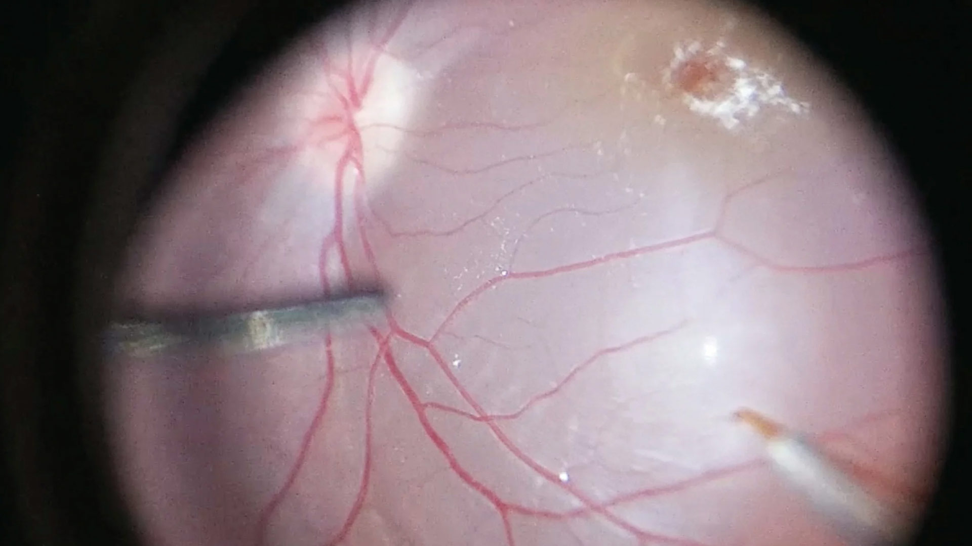 Routine exam reveals unusual retinal findings