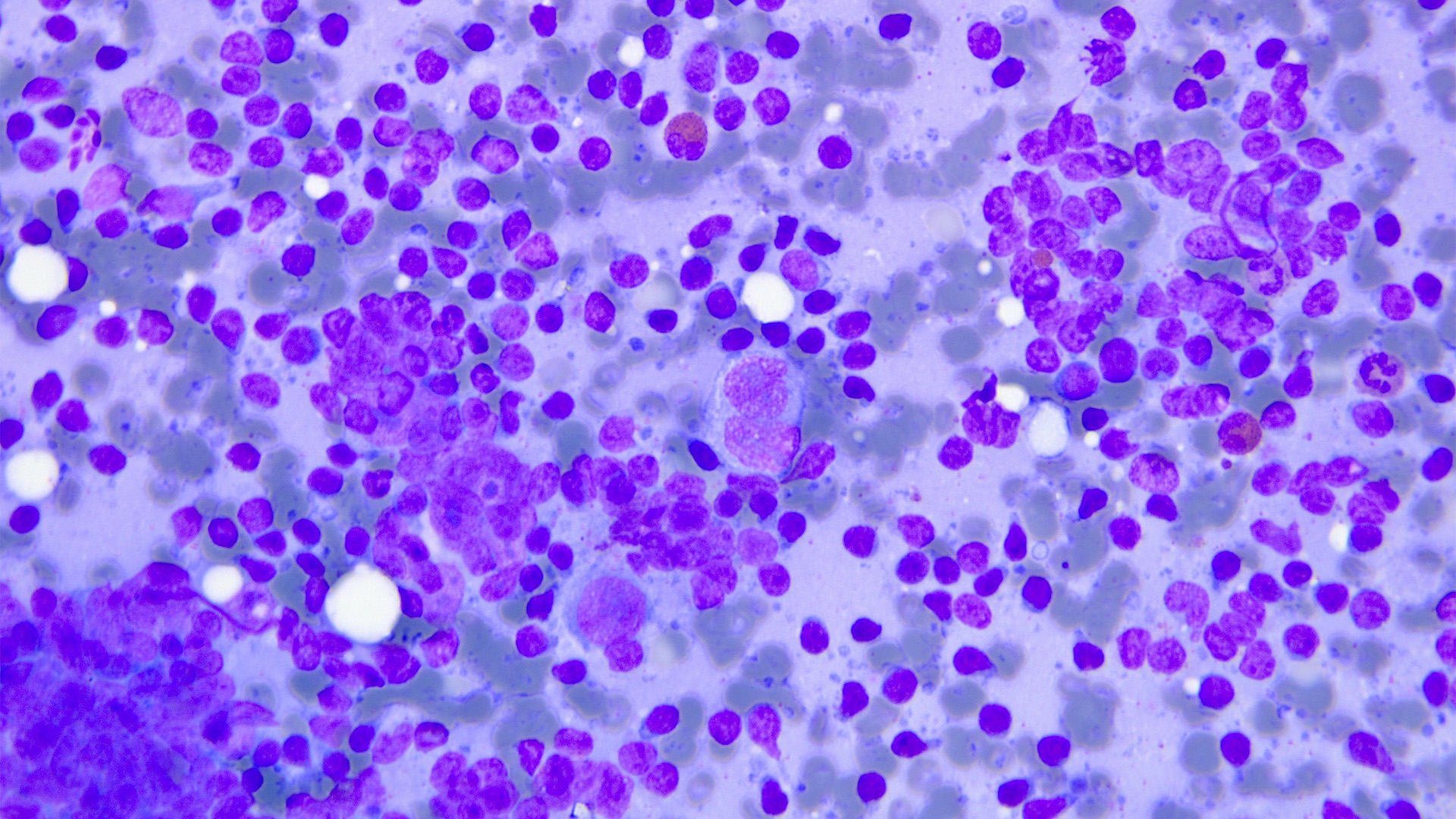Image of tissue stained with Papanicolaou showing hodgkin lymphoma. 